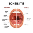 Tonsils and throat diseases. Tonsillitis symptoms. Anatomy of human mouth.
