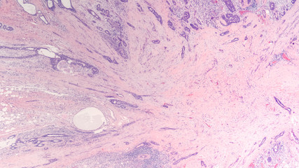 Wall Mural - Radial scar of the breast is a benign lesion that can mimic cancer both by radiology and histology and may be associated with cancer in up to 30% of cases.  