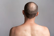 © _KUBE_ - The concept of male alopecia and hair loss. Rear view of the man's head with a bald spot. Bare shoulders