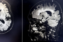 Brain MRI For Education Dementia Mix Type Stroke VaD