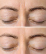 © Kaspars Grinvalds - Woman's face skin before and after aesthetic beauty cosmetic procedures with removed skin wrinkles