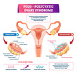 Polycystic ovary syndrome vector illustration. Labeled reproductive disease