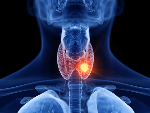 3d rendered medically accurate illustration of thyroid cancer