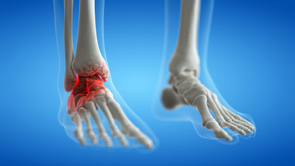 Wall Mural - 3d rendered medically accurate illustration of an arthritic ankle joint