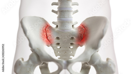 Fotomural 3d rendered medically accurate illustration of an arthritic iliosacral joint
