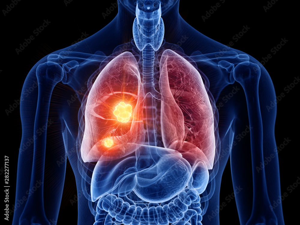 3d rendered medically accurate illustration of lung cancer Stock ...