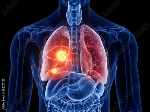 3d rendered medically accurate illustration of lung cancer © SciePro