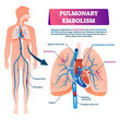 Pulmonary embolism vector illustration. Labeled lung blood blockage scheme