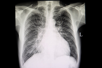 congestive heart failure