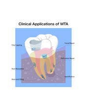 歯科MTA