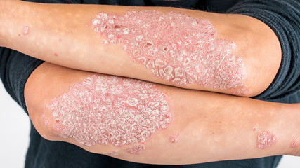 man with sick hands, dry flaky skin on his hand with vulgar psoriasis, eczema and other skin disease