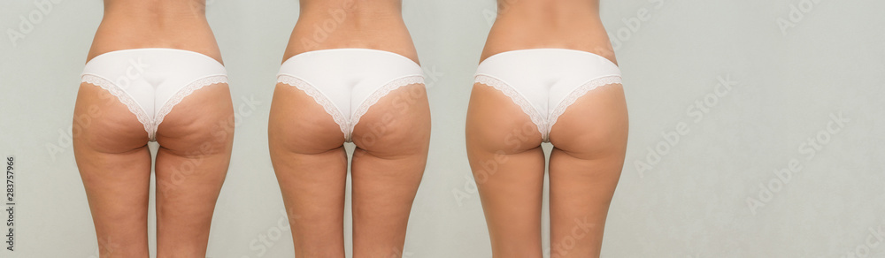 Female buttocks before and after treatment. panoramic - obrazy, fototapety, plakaty 