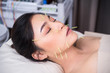 © geargodz - woman undergoing acupuncture treatment on face
