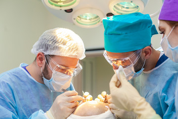 Baldness treatment. Hair transplant. Surgeons in the operating room carry out hair transplant surgery. Surgical technique that moves hair follicles from a part of the head.