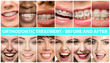 © master1305 - Beautiful close up male and female portraits. Concept of beauty, correction, treatment and teeth whitening. Braces, veneers, implantation, dentistry. Before and after. Colorful flyer for your