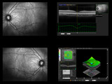 Fototapeta Las - Ophthalmic test - OCT optical coherence tomography measurement. Scan of the macula in retina, layers and thickness of retina.