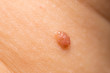 Macro of Papillomas or mole on female neck close up background