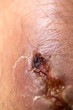 © sinhyu - Closeup injured at leg, Fresh wounds from accident.