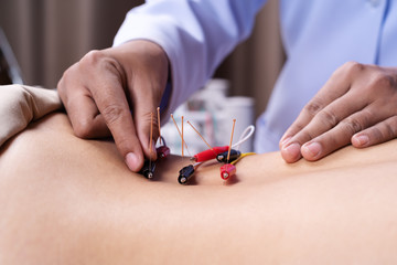 Wall Mural - woman undergoing acupuncture treatment with electrical stimulator on back