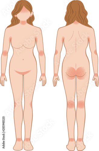 あせも 湿疹 全身 女性 Stock Vector Adobe Stock あせも 湿疹 全身 女性 Stock Vector Adobe Stock