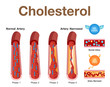 Cholesterol in artery, health risk , vector design