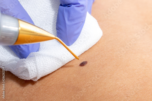 Fotografía Macro close up of laser plasma pen removing wart on human skin.