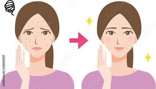女性 ニキビ ビフォーアフター 美容イラスト Stock Vector Adobe Stock 女性 ニキビ ビフォーアフター 美容イラスト Stock Vector Adobe Stock