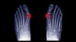 © Joel bubble ben - Film X-ray foot radiograph show both Hallux valgus deformity or Bunion disease. The patient has big toe pain symptom ,shoe wearing and cosmetic problem. Highlight on painful area. Medical concept