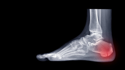 Wall Mural - Film ankle X-ray radiograph showing heel bone fracture (Calcaneus fracture) after fall from height. The patient had heel pain. Highlight on broken bone site and painful area. Medical imaging concept