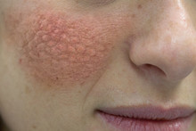 Close Up Of Young Caucasian Women Face With Red Cheeks That Cause Skin Problems