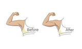 Female biceps and triceps before and after sport. Arms showing progress  after fitness. Bent arm with bat wing vs well toned arm. Vector  illustration for beauty, cosmetology Stock Vector