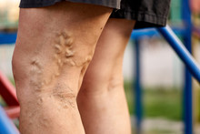 Painful Varicose And Spider Veins On Womans Legs, Who Is Active, Self-helping Herself. Healthcare