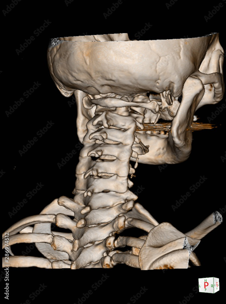 CT Scan cervical spine 3 D render and X-ray C-spine finding Reverse ...