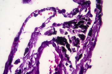 Sticker - Histopathology of smoker's lung. Light micrograph showing accumulation of carbon particles in lung tissue