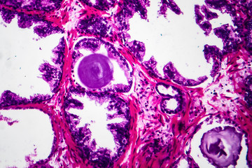 Poster - Benign prostatic hyperplasia, light micrograph, photo under microscope showing dilated glands, papillary projections inside the glands lumen, accumulation of secretory material