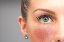 Red Flushing Cheeks Are Seen Closeup, In The Face Of A Stunning Thirty Something Caucasian Girl, Permanent Redness And Small Visible Blood Vessels, Symptoms Of Rosacea With Room For Copy.