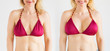 Woman posing in bikini top before and after breast augmentation plastic surgery with silicone breast implants