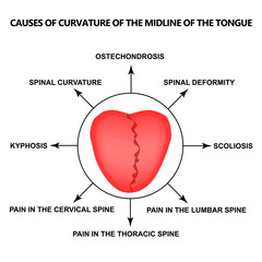 Wall Mural - Causes of curvature of the midline of the tongue. Definition of a disease according to human tongue. Diagnostics by tongue. Tongue Vector illustration on isolated background.