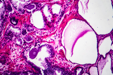 Wall Mural - Benign prostatic hyperplasia, light micrograph, photo under microscope showing dilated glands, papillary projections inside the glands lumen, accumulation of secretory material