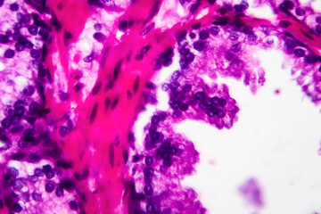 Sticker - Benign prostatic hyperplasia, light micrograph, photo under microscope. High magnification showing papillary projections inside the lumen of the glands