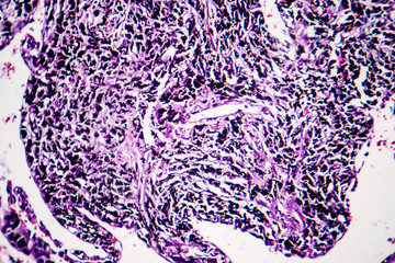 Sticker - Histopathology of smoker's lung. Light micrograph showing accumulation of carbon particles in lung tissue