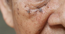 Close Up Skin Tags On Wrinkles Skin Of Asian Woman Face
