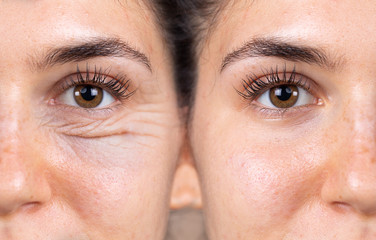 A young woman shows the before and after results of successful blepharoplasty surgery, corrective procedure to remove puffy and swollen bags beneath the eye.