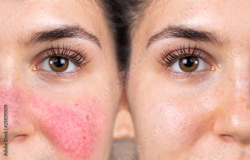 Fotografía Before and after successful rosacea treatment on the face of a caucasian lady