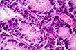 Histopathology of stomach adenocarcinoma, light micrograph, photo under microscope