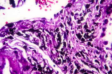 Sticker - Histopathology of smoker's lung. Light micrograph showing accumulation of carbon particles in lung tissue