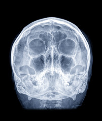 Poster -  Skull x-ray image of Human skull  water view for demonstrate facial bone isolated on Black Background.