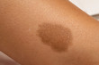 A closeup view of a large brown birthmark on the leg of a person, normally harmless and benign skin pigmentation can cause anxiety of appearance.