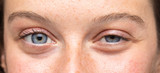 Fototapeta  - A beautiful young woman is viewed up close as she looks towards the camera, details of the eyes and swollen eyelids from a bacterial infection.