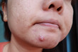 Woman squeezing pimple with dirty bare hands, Removing pustules whitehead acne from face, Problems with acne and scar on the female skin.